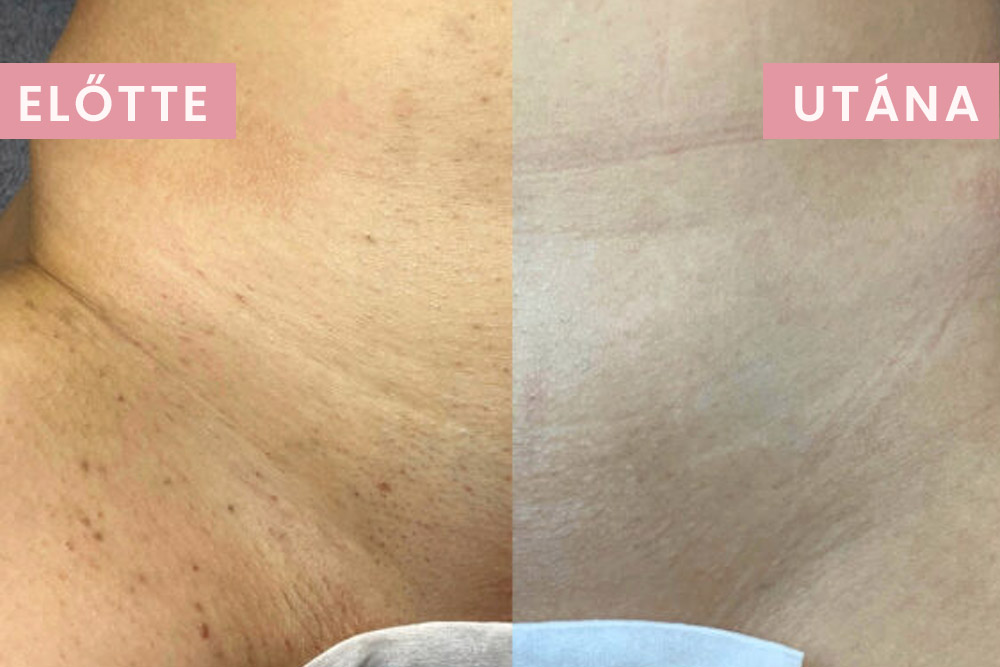 Lézeres szőrtelenítés előtte utána