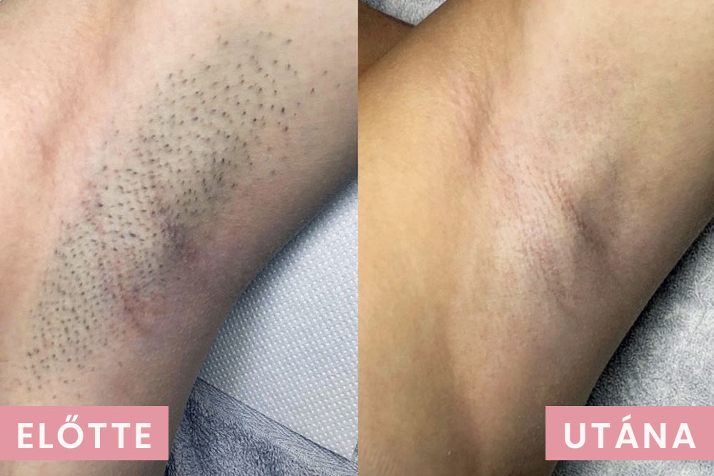 Hónalj szőrtelenítés előtte utána