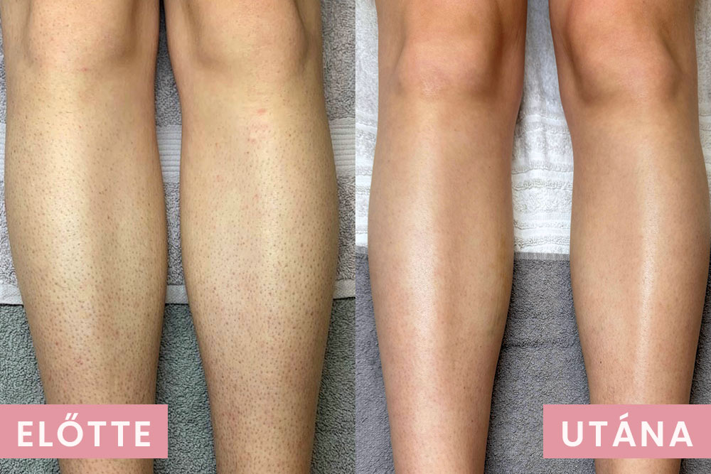 Lézeres lábszőrtelenítés előtte utána