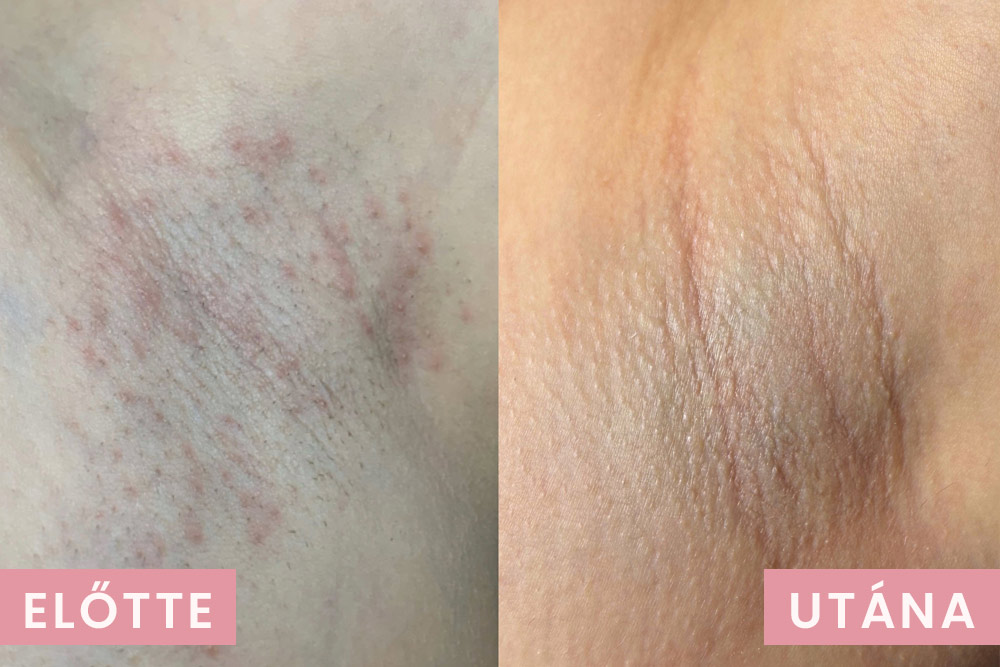 Szőrtüszőgyulladás előtte utána