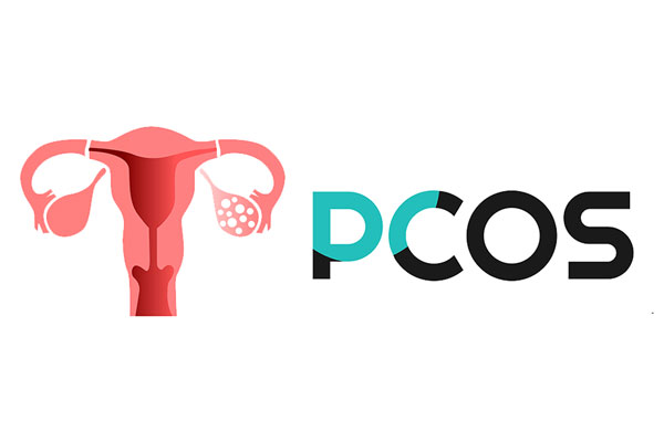 Sokéves gyakorlat PCOS-es vendégekkel