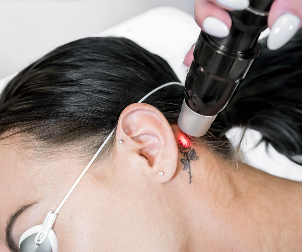 Lézeres Tetoválás Eltávolítás